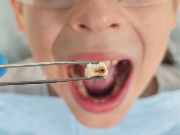 Best Emergency Gum Treatment in Shoshone, ID
